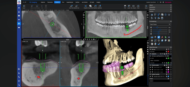 CBCT-røntgen hos Tandlægerne Torvet I:S - 2