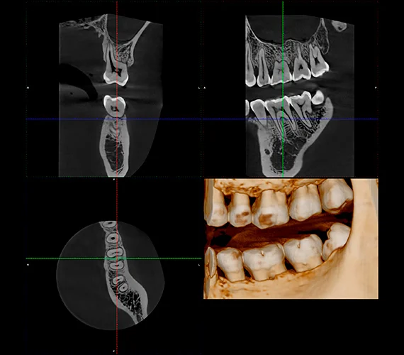CBCT-røntgen hos Tandlægerne Torvet I:S - 3